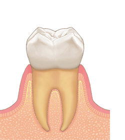 歯周病